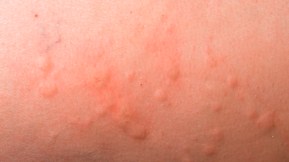 Hives and skin reactions can occur with taking antibiotic