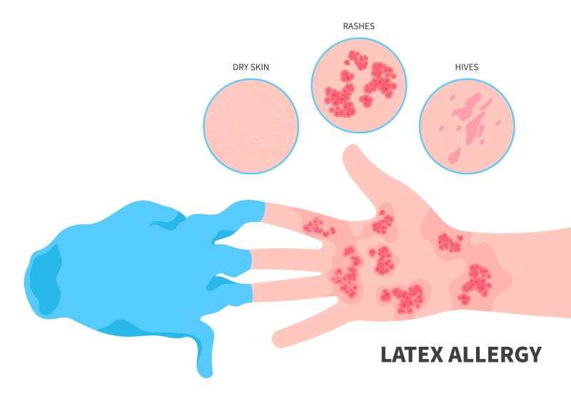 Latex Allergies 101 : NCHPAD - Building Healthy Inclusive Communities